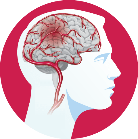 علائم سکته مغزی چیست